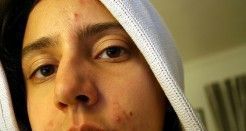 chico con acne